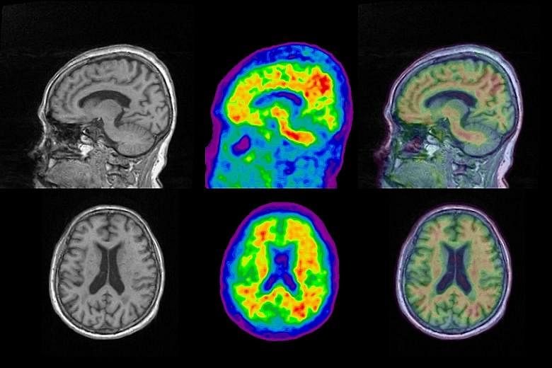 An MRI scan (far left) shows brain structure, while a PET scan (centre) lets researchers see amyloid presence in red. Combining the two images (left) could help doctors find out which parts of the brain have a build-up of the protein linked to Alzhei