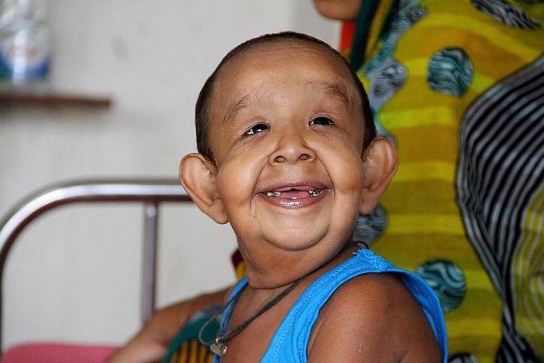Four-year-old Bayezid Shikdar at Dhaka Medical College Hospital on Sunday. Born with excess skin that hangs from his limbs and face causing it to sag, he also suffers from related heart, vision and hearing problems.