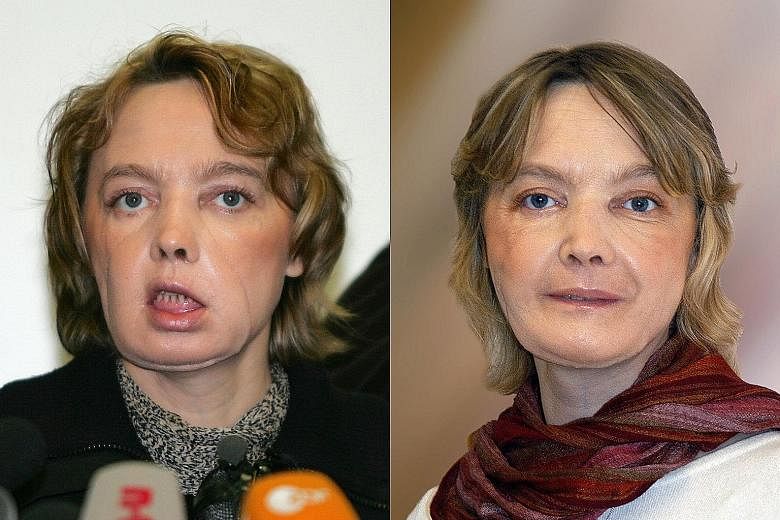 Mrs Dinoire in February 2006 (left) and November 2006, after receiving a graft comprising the nose, lips and chin in 2005.