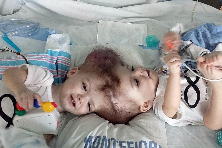 Left: 13-month-old twins Jadon and Anias McDonald before they underwent 16-hour surgery. Above: Jadon recovering after the procedure. Although the surgery was a success, the outlook for the brothers' health remains unclear