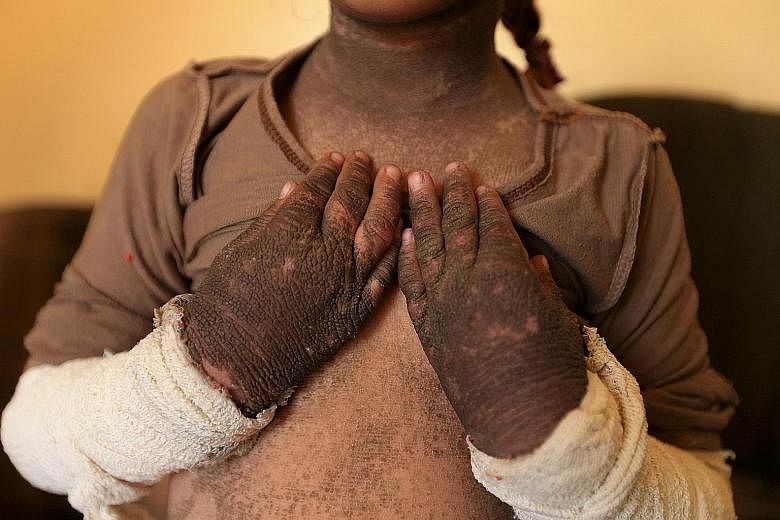 Weeks after the rocket attack, five-year-old Doaa is still in severe pain and the skin on her arms and neck is blackened and hard.