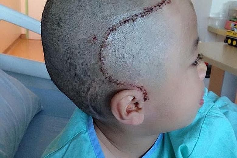 The scars on Javier Lim's skull are proof of the painful operations he has had over the past three years.
