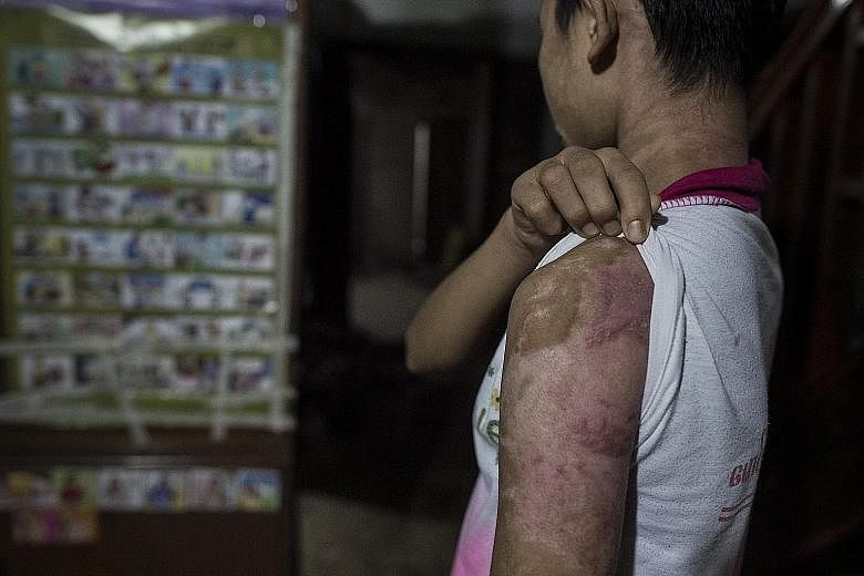 In this photo taken on Monday, Khin Khin Tun, 14, shows the scars that were the result of years of abuse. Her former employer is now on trial for causing grievous bodily harm.