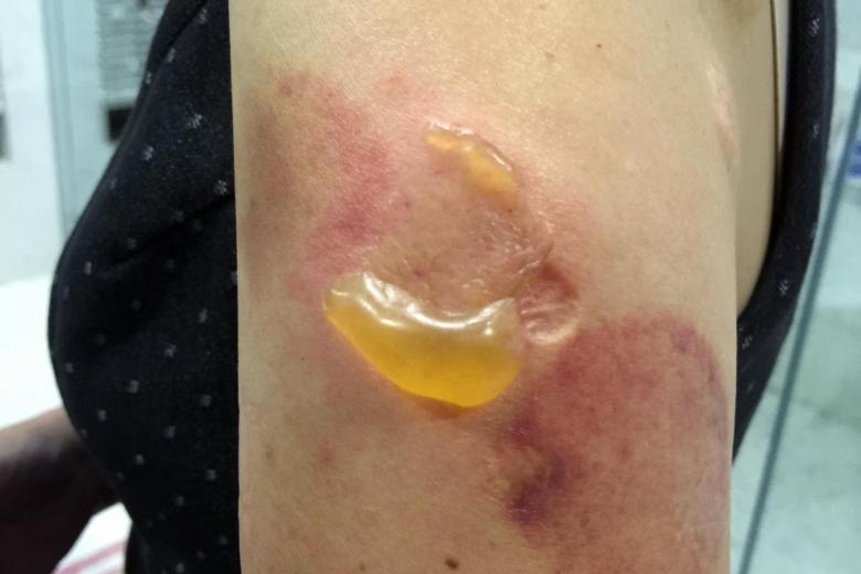 Woman suffers thirddegree burn and scarring after moxibustion TCM