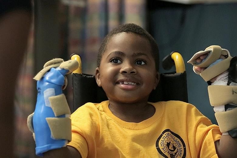 Zion Harvey with his newly transplanted hands in July 2015. Eight months after the operation, Zion was using scissors and drawing with crayons. Scans have shown that his brain is adapting to the new hands, developing new pathways to control movement 