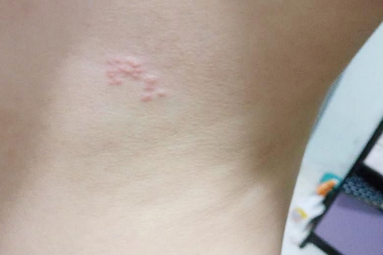 Last Friday afternoon, Ms Debra Low posted a complaint on GV's Facebook page showing photos of bumps on her skin. She said she had watched a movie in Junction 8 on Aug 7 and found the bumps when she got home.