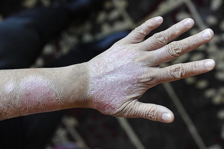 Psoriasis usually shows up as thick, red patches that can be itchy, scaly and can peel.