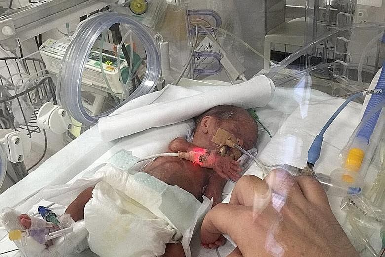 Oliver spent the first 201 days of his life inside a hospital incubator, with tubes and tapes all over his tiny body.