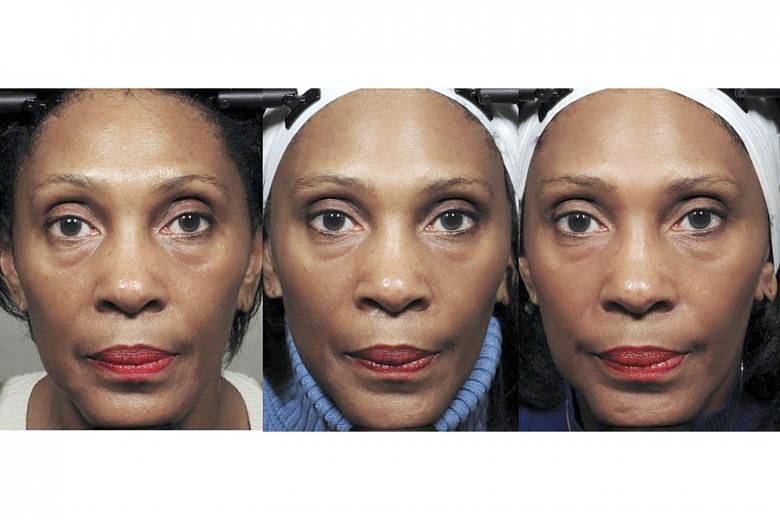 The effects of the exercises on one of the Northwestern University Feinberg School of Medicine test subjects were judged to be modest improvements to the upper cheeks and eye bags, starting at week eight (centre) and, by week 20 (right). But many of 