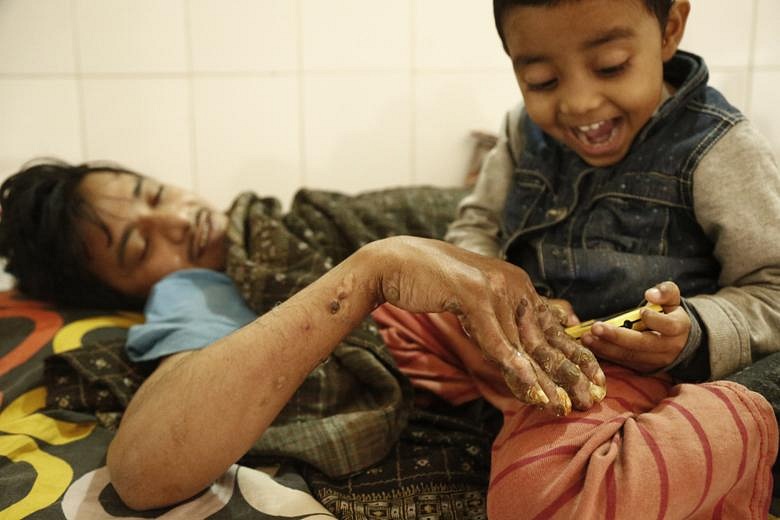 After 24 Surgeries Bangladesh Tree Man Relapses The Straits Times 