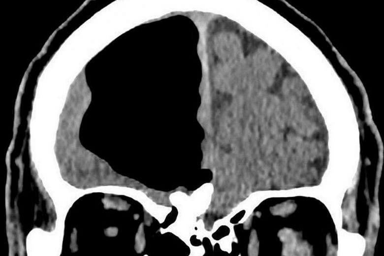 After CT and MRI scans, the medical team of an 84-year-old patient made an alarming discovery: Where much of the man's right frontal lobe of his brain should have been, there was simply a large blank space.
