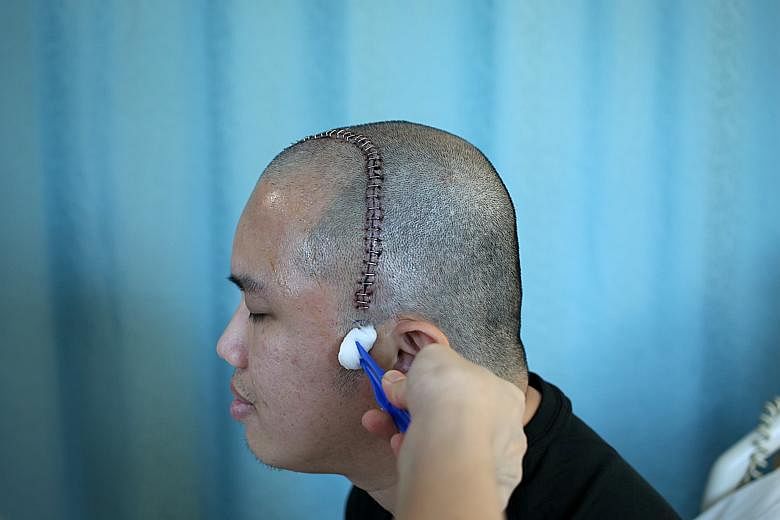 He went through brain surgery - awake | The Straits Times