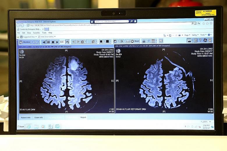 MRI scans showing the brain before (left) and after the operation. When a mass is removed, the brain will often re-expand back to what it should be. Operating theatre nurses placing the walnut-size tumour into a container for it to be sent for biopsy