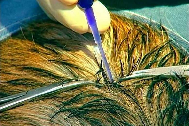 Associate Professor Marcus Ong's method uses hair and tissue glue to seal a head wound, thus avoiding the need for stitching and shaving.