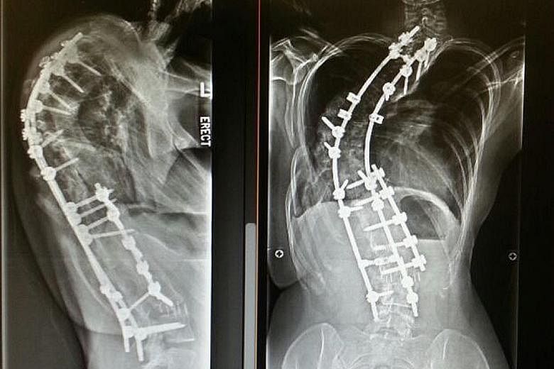 Ms Nur Afifah is believed to have one of the most severe cases of scoliosis here (see X-rays below). After a 13-hour operation in April, she now has three metal rods and 19 screws in her spine, but she no longer battles excruciating pain every day an