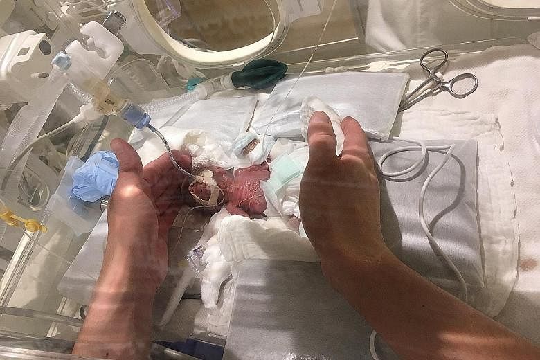 This tiny baby was delivered at 24 weeks, last August, reportedly after he stopped growing in his mother's womb. He was so small that he could fit in an adult's cupped hands, said Keio University Hospital in Tokyo where the infant was born. The baby,