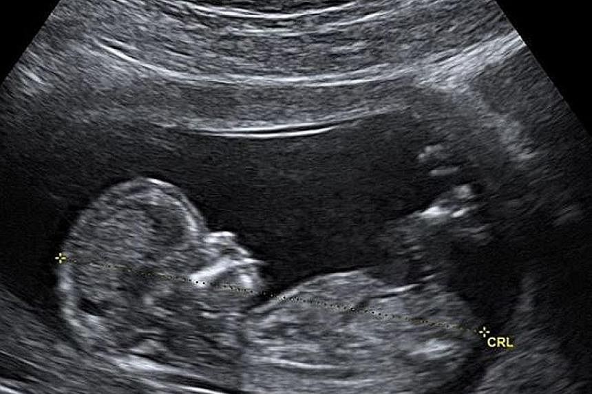 BABY BLUES FOR APRIL'S FOOL: Singer Justin Bieber posted an ultrasound image of a womb on Monday, triggering netizens to speculate that his wife was pregnant with their first child. The singer, 25, followed up with another photo that showed Hailey Ba