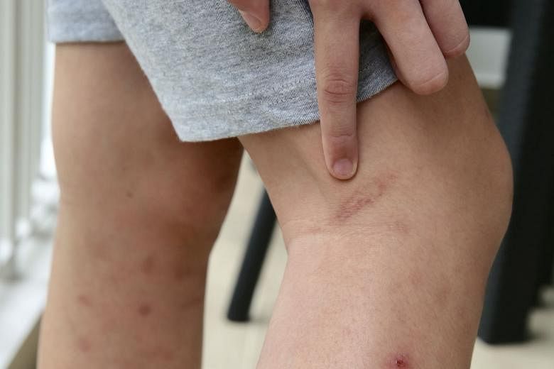 Ms Claire Kang, the pupil's mother, discovered cane marks on her son's arms and legs. She says that the school's discipline headmistress caned her son and a classmate without informing the boys' parents.