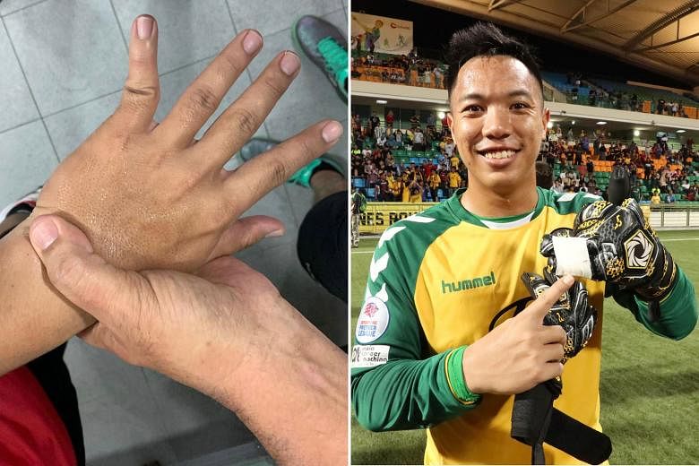 Tampines goalie Syazwan Buhari popped his left little finger (left) back into place and played with his last two fingers taped together (below) in the Singapore Cup final. PHOTOS COURTESY OF SYAZWAN BUHARI
