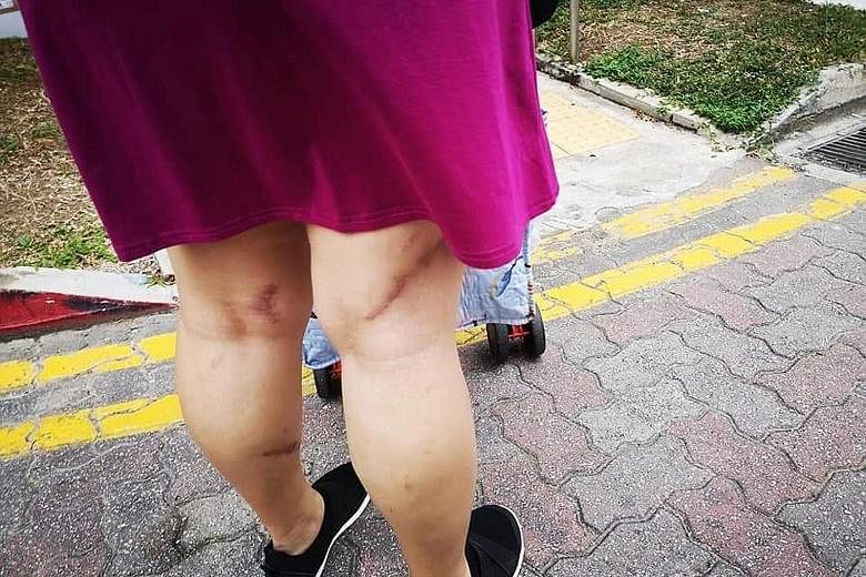Madam Alice Ng was cut badly on her legs during the boar attack two years ago. Her injuries were so serious she had to undergo three operations. The latest wild boar attacks on humans in Punggol Walk bring the number of incidents to four so far this 
