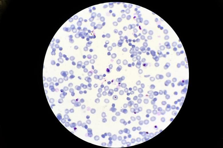 Left, above: A microscopic view of human red blood cells (stained light purple) infected with the malaria parasite (visible as blue dots). Left: A scanning electron microscopy image of three red blood cells infected with malaria parasites and a human