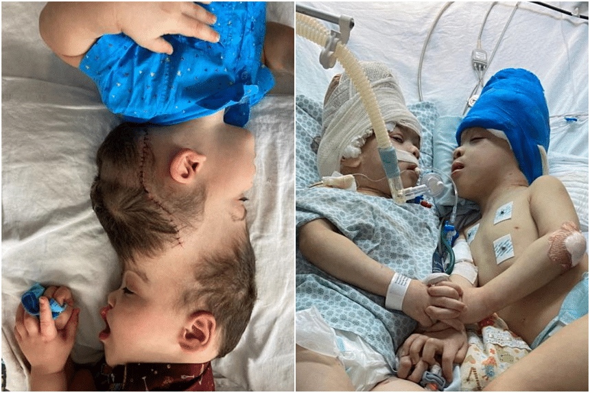 Conjoined twins separated with help of virtual reality in Brazil The