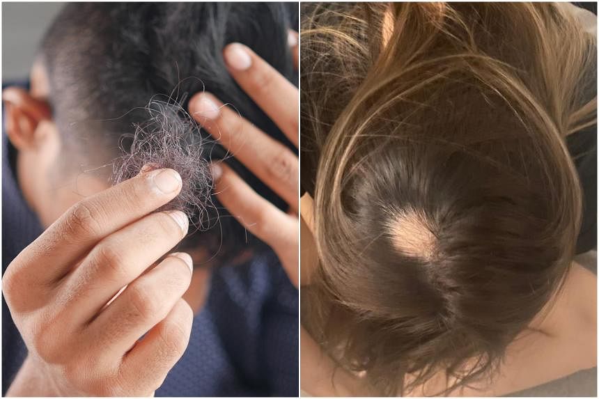 Hair loss common among those infected with Covid-19 | The Straits Times