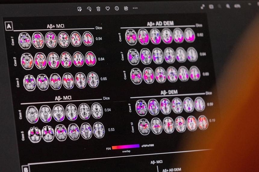 New US-approved drug for early-stage Alzheimer’s disease not yet available here