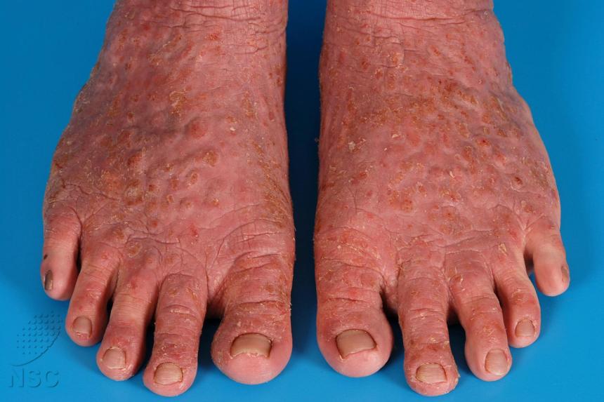 National Skin Centre gets 10m grant to study eczema, reduce rates of