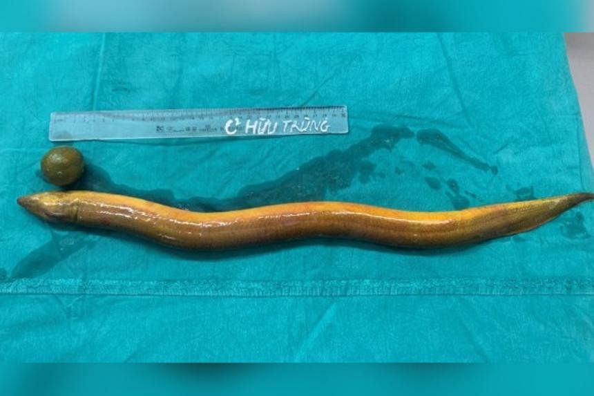 Man in Vietnam inserts live eel up his rear punctures colon  