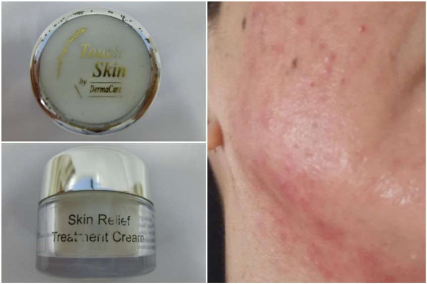HSA warns against using skin cream with potent steroid after woman ...