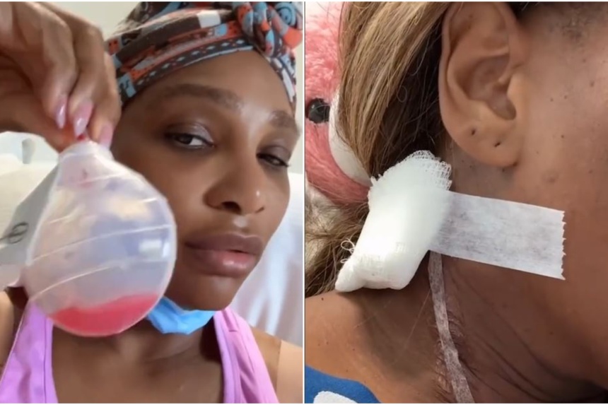 Serena Williams 'All is OK' after surgery to remove large cyst The