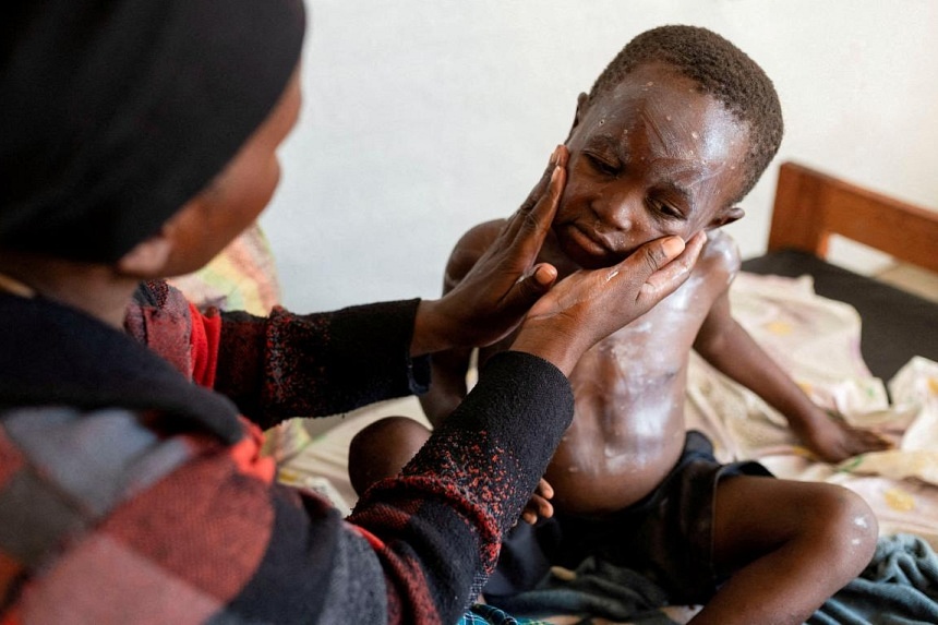 New mpox vaccines for Congo's children held up by old problem