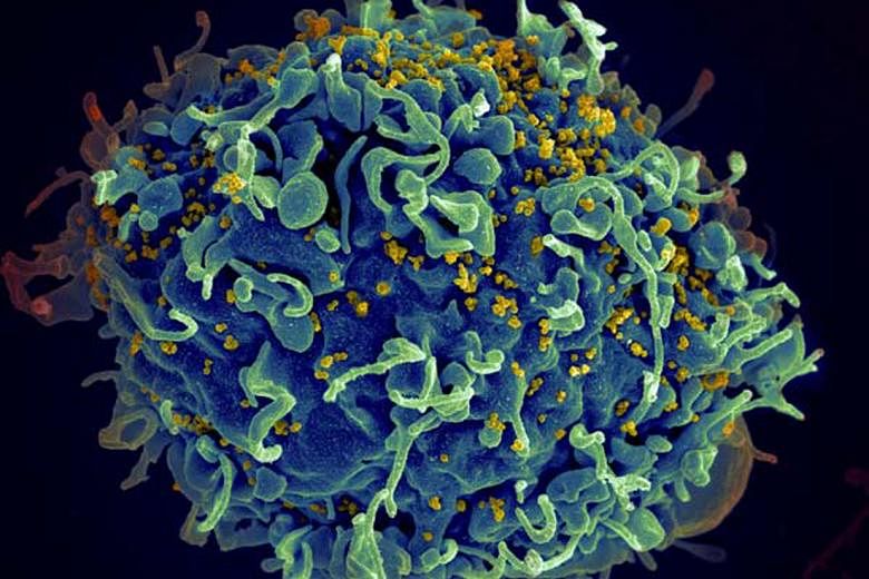 HIV (seen in yellow) infecting a human immune cell. The virus destroys or impairs the function of such cells. The most advanced stage of an HIV infection is Aids, and it usually takes between 10 and 15 years for an infected person to develop Aids. Ef