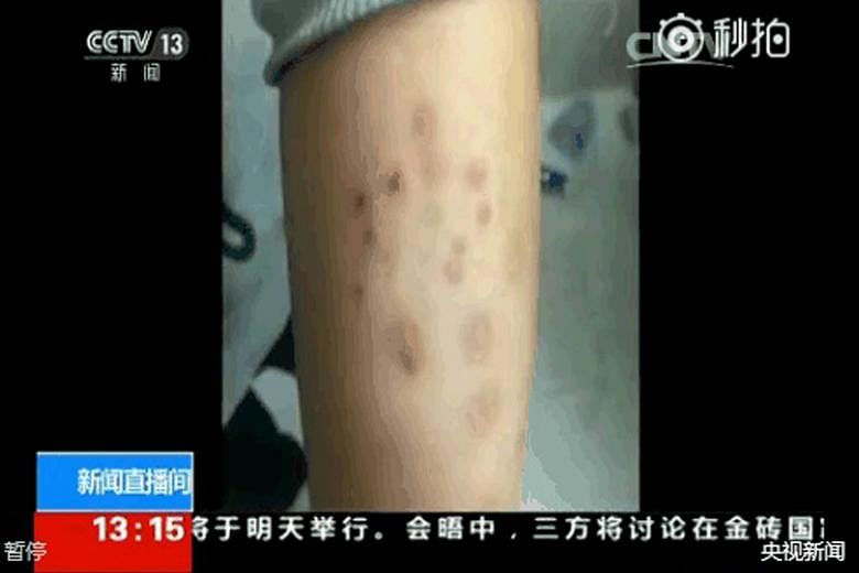 Two screen grabs taken off Sunday's CCTV broadcast show skin abnormalities and marks on affected students of Changzhou Foreign Languages School. It was reported that soil and groundwater in the area were found to contain toxic compounds and heavy met
