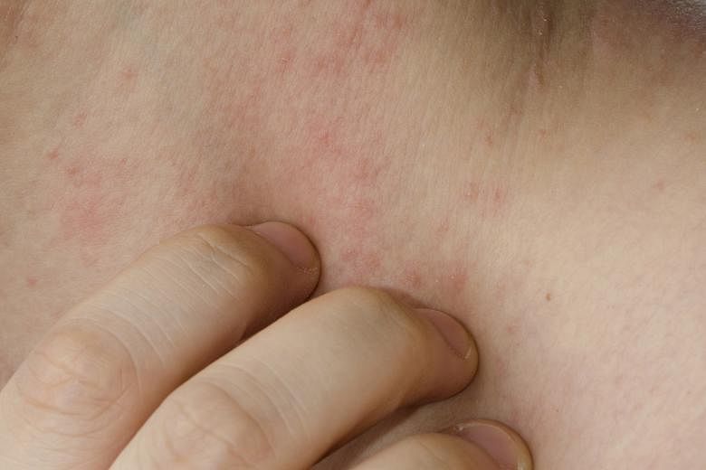 Consult a doctor if you have tried self-medication on a skin rash without success.