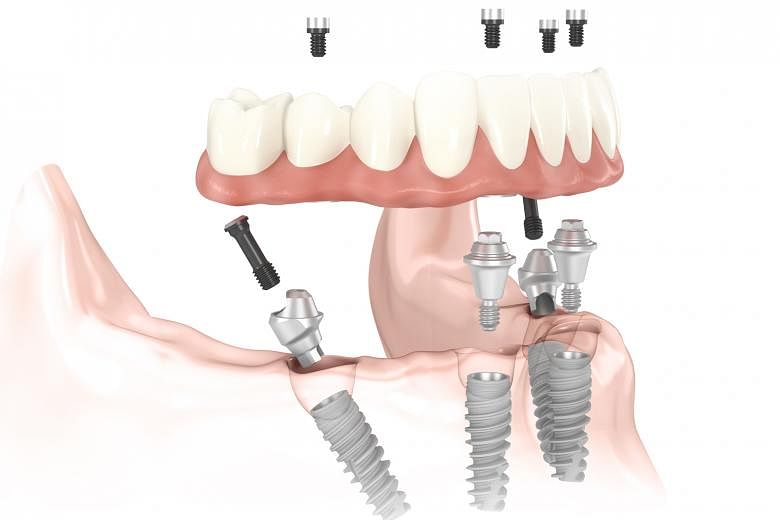 The All-On-Four dental implant procedure (above) tilts two of the implants to ensure a secure base for the full denture. A set of complete dentures (below) will replace all your missing teeth.